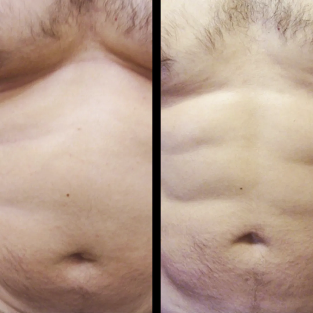 HD Lipo abdomen before and after result